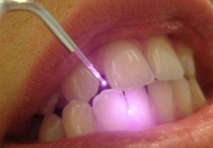 Професійне чищення зубів: види, показання, особливості проведення гігієнічної процедури в домашніх умовах