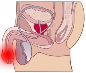 Ріжучі болі при сечовипусканні у чоловіків і виділення з уретри: причини, діагностика, методи лікування 