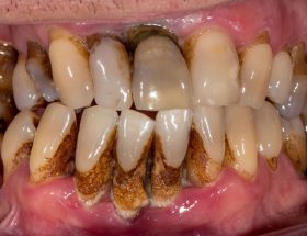 Патологічна рухливість зубів у дорослих - що робити?