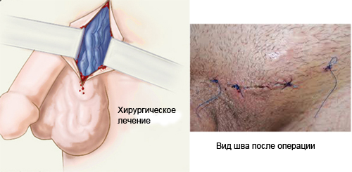 Варикоцеле - симптоми, причини розвитку, ступеня варикоцеле і методи лікування.