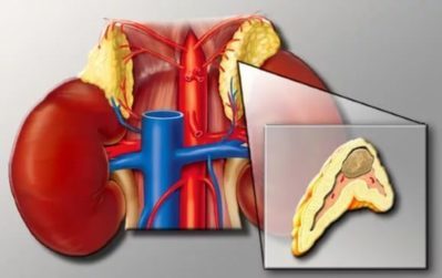 Пухлини надниркових залоз: симптоми у жінок і чоловіків, лікування операція оп видалення