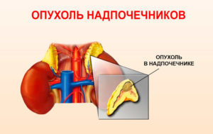 Пухлини надниркових залоз: симптоми у жінок і чоловіків, лікування операція оп видалення