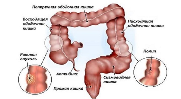 Доброякісні пухлини товстого кишечника: причини, симптоми, методи діагностики і лікування