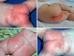 Алергія на памперси або підгузники: симптоми і лікування