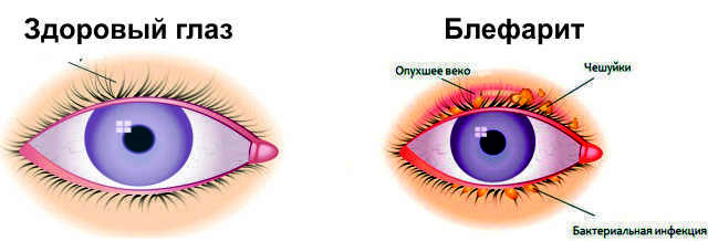 Що робити, якщо опух очей і болить, лікування в домашніх умовах