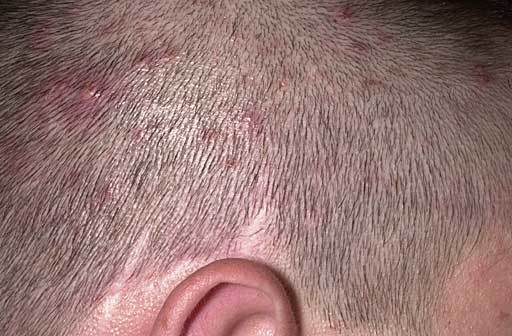 Прищі на голові в волоссі у чоловіка: причини і лікування, фото
