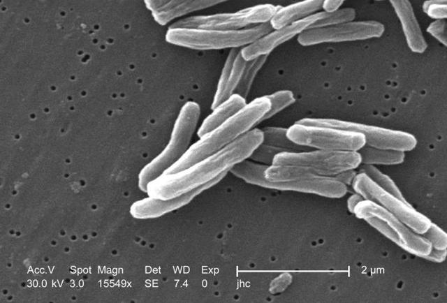 Посів мокроти на туберкульоз: скільки робиться, розшифровка, як збирати і здавати