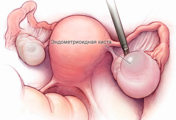 Ендометріоїдна кіста яєчника: симптоми, лікування без операції, розміри для операції