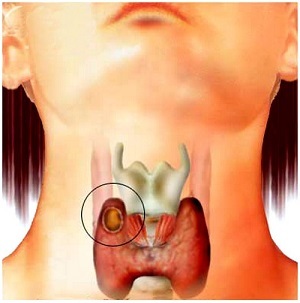 Як лікувати кісту щитовидної залози: причини, симптоми і лікування кіст щитовидної залози