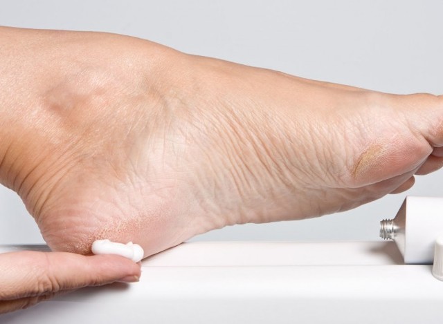 Як лікувати натоптиші на підошві ніг: народні засоби і аптечні препарати
