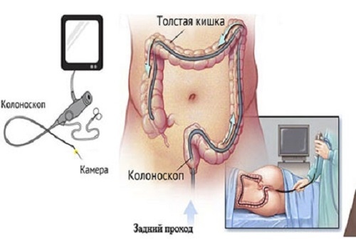 Колоноскопія: суть методу, показання та правила підготовки до процедури | ОкейДок