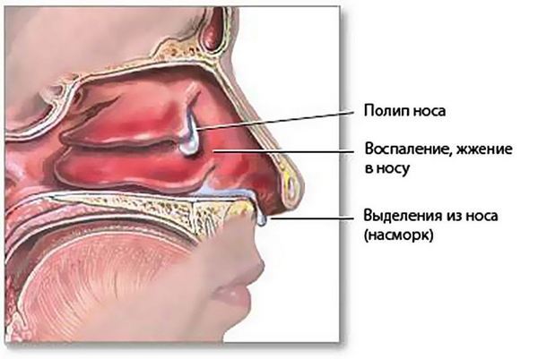 Печіння в носі при нежиті та застуді: причини і лікування