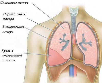 Легенева кровотеча: ознаки, діагностика та невідкладна допомога