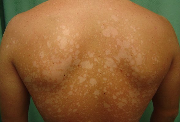 Висип на шкірі, що супроводжується свербінням і больовими відчуттями: причини, діагностика, лікування