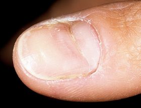 Лінії Бо-Рейлі на нігтях, борозни на нігтьової пластини: як виглядають, чому з'являються, лікування
