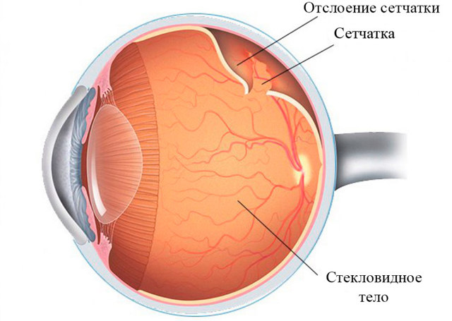 Ретиніт - симптоми, лікування, причини інфекційно-запального, пігментного ретиніт