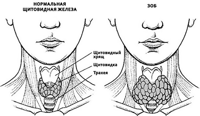 Вузловий зоб щитовидної залози - симптоми і лікування, діагностика зоба