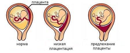 Кровотеча в другій половині вагітності: причини, методи лікування, прогноз при кровотечі на пізньому терміні вагітності