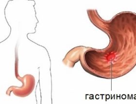 Гастринома: механізм розвитку, супутні симптоми, способи лікування та можливі ускладнення