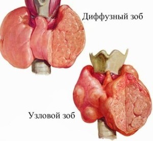 Як розшифрувати УЗД щитовидки при підозрі на дифузний зоб: які норми обсягу щитовидної залози?