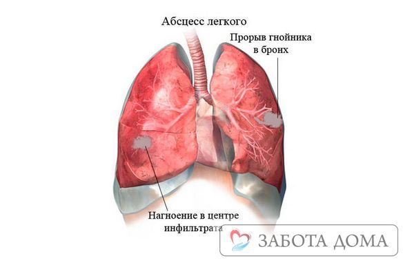 Смерть від пневмонії - причини летального результату при запаленні легенів