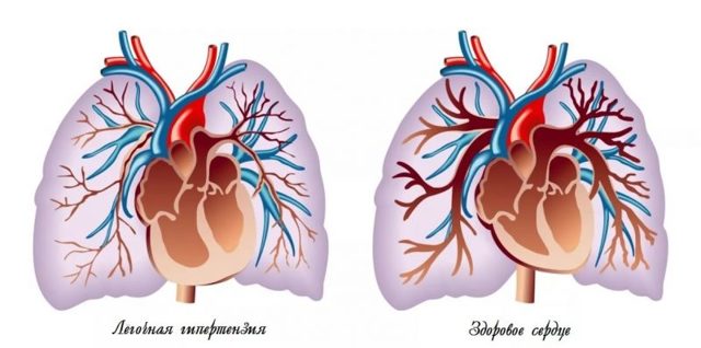 Легеневе серце: діагностика та лікування, скільки з цим живуть