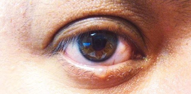 Як лікувати чиряк на оці, лікування фурункула на оці