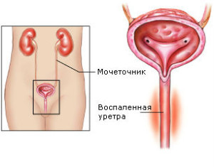Уретрит у жінок: симптоми, лікування, препарати при уретриті у жінок