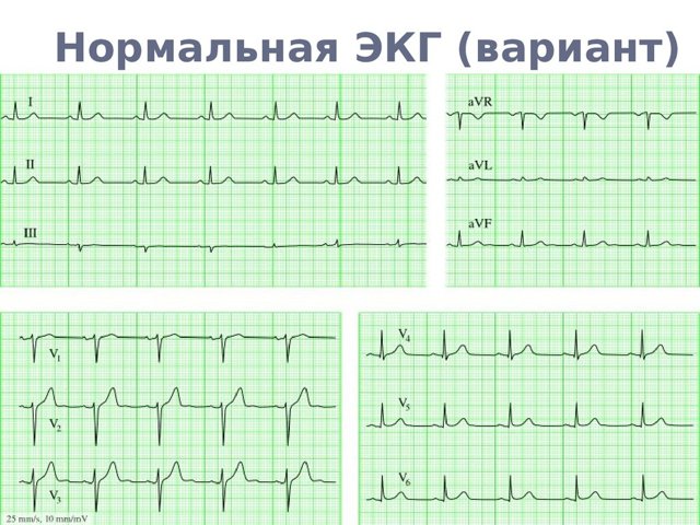 Розшифровка ЕКГ: норма кардіограми серця, як розшифрувати її самостійно