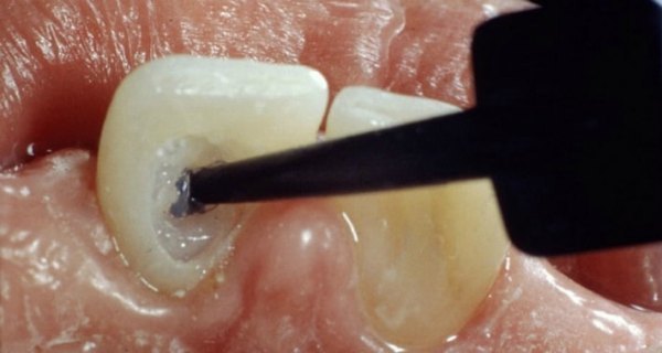 Ендоотбеліваніе зубів, внутрішньокоронкове відбілювання зуба: що це таке, препарати