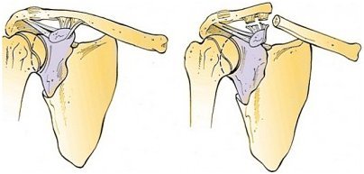 Перелом лопатки - лікування, іммобілізація і реабілітація після перелому лопатки