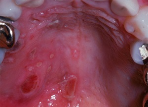 Виразки в роті: причини і лікування в домашніх умовах, фото, виразки в роті при ВІЛ