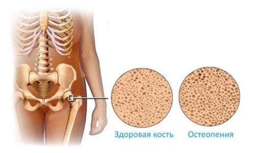 Остеомаляція стегнової кістки, берда: причини, симптоми, лікування, профілактика