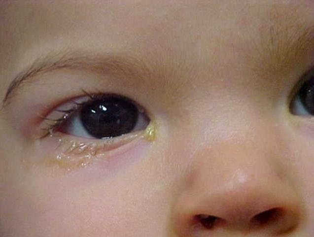 У дитини нежить і гниють очі: причини і лікування