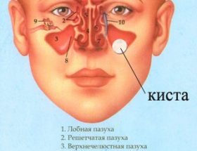 Кіста в носовій пазусі: симптоми і лікування, операція, наслідки