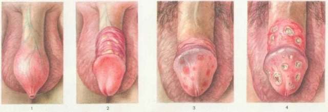 Гонорея у жінок: перші ознаки, симптоми і лікування, фото виділень при гонореї