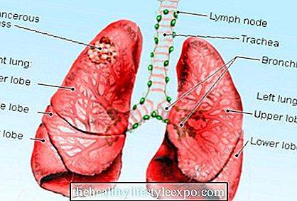 Пневмонія при раку легенів: діагностика, симптоми і лікування