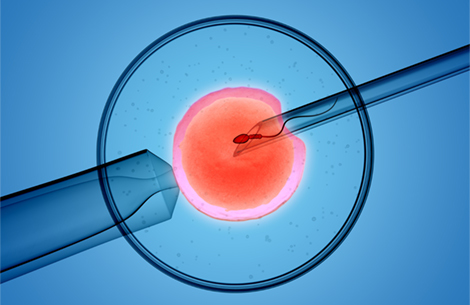 Штучна інсемінація, запліднення донорською спермою