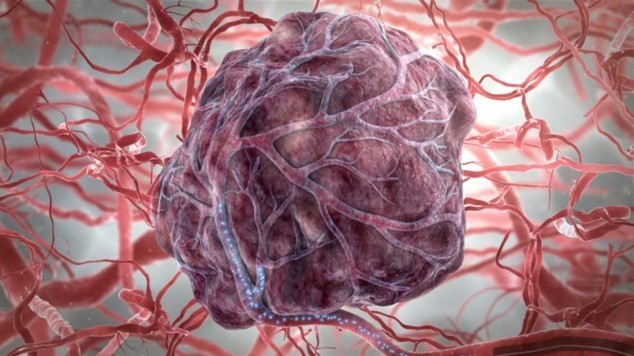 Рак кишечника 4 стадії і метастази: ознаки швидкої смерті і скільки живуть люди