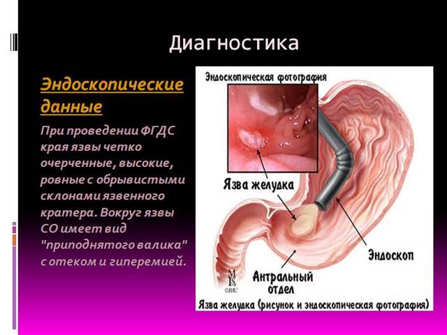 Виразка шлунка: лікування медикаментозними засобами і за допомогою народних засобів