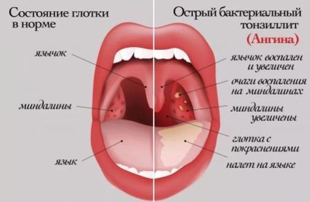Таблетки від болю в горлі: кращі і ефективні засоби, що приймати