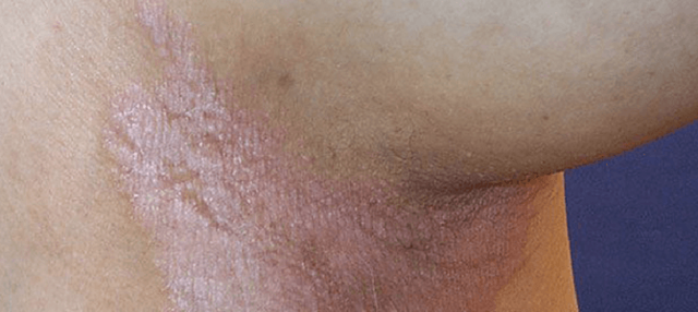 Інтертрігинозний псоріаз складок шкіри: причини, симптоми, лікування, діагностика