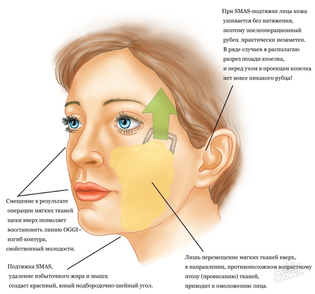 Як прибрати брилі в домашніх умовах, підтяжка обличчя, операції при обвислій шкірі обличчя