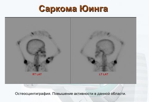 Що таке сцинтиграфія кісток і органів, що показує сцинтиграфія