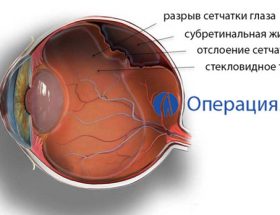 Відшарування і дегенерація сітківки ока - причини, симптоми, лікування, операція