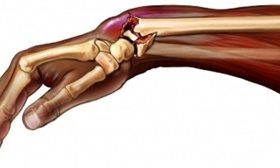 Перелом променевої кістки в типовому місці без зміщення і зі змішанням, як розробити руку