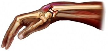Перелом променевої кістки в типовому місці без зміщення і зі змішанням, як розробити руку