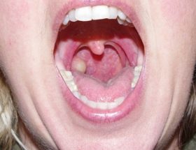 Кіста гортані: класифікація пухлин, причини виникнення, клінічні симптоми