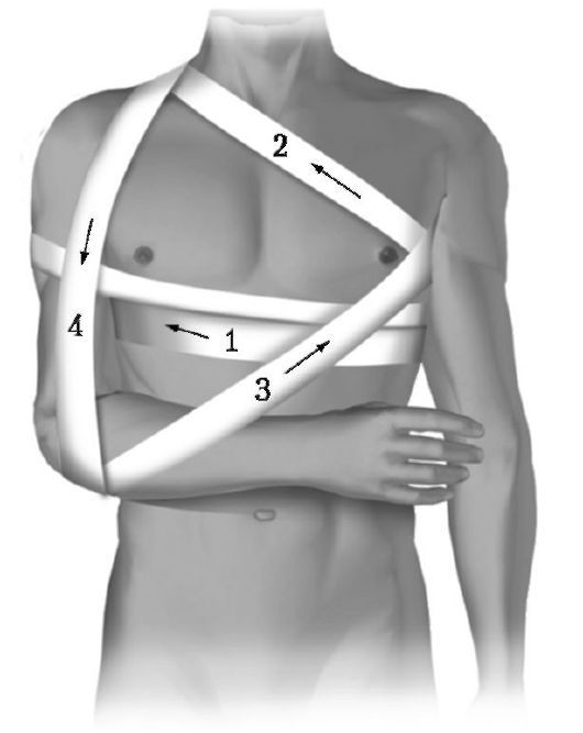 Перевязка ключицы. Наложение повязки Дезо алгоритм. Повязка Дезо алгоритм. Повязка Дезо техника наложения. Технику наложения повязки Дезо..