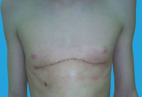 Килевидная грудна клітка у дитини: як виправити деформацію, операція, лікування